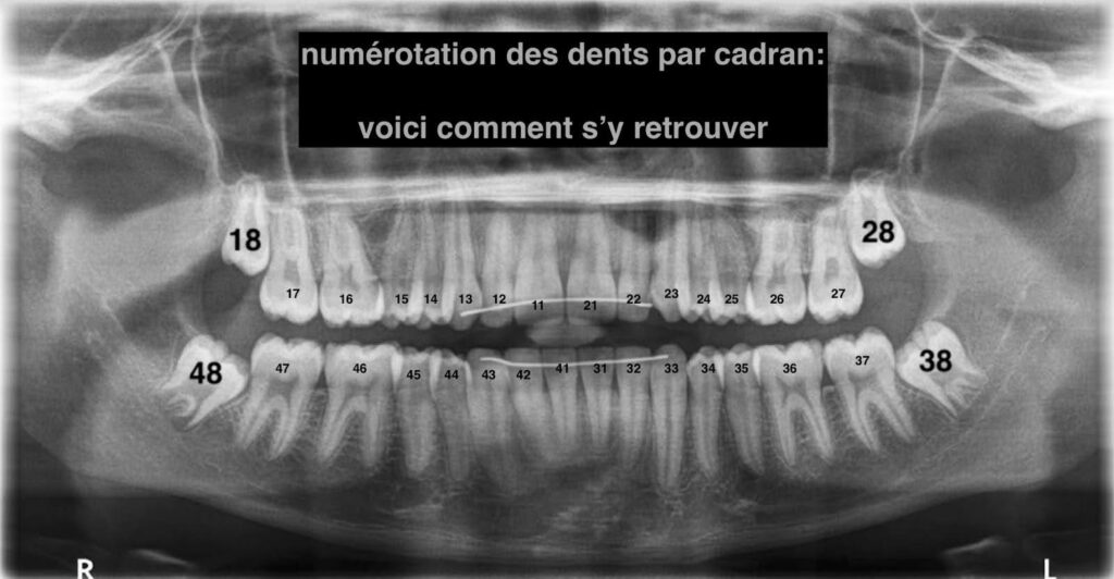 Dents de sagesse