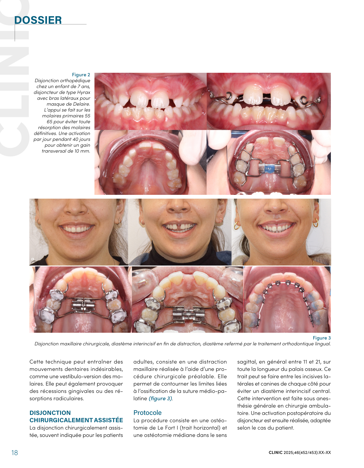 Disjonction orthopédique chez un enfant de 7 ans (disjoncteur de type Hyrax) et disjonction maxillaire chirurgicale : diastème interincisif en fin de distraction, refermé par le traitement orthodontique — CLINIC 2025, figures 2 et 3.