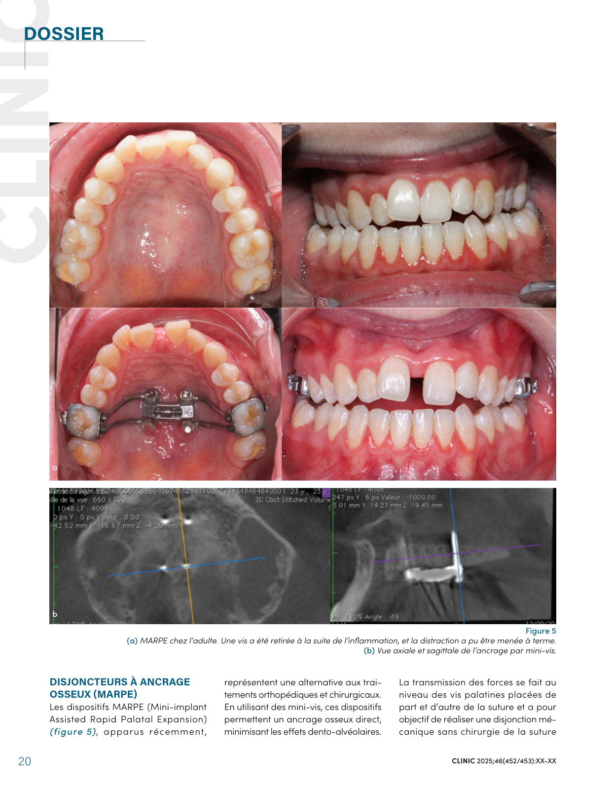 MARPE chez l'adulte : disjoncteur à ancrage osseux par mini-vis et contrôle CBCT de l'ancrage bi-cortical — CLINIC 2025, figure 5.