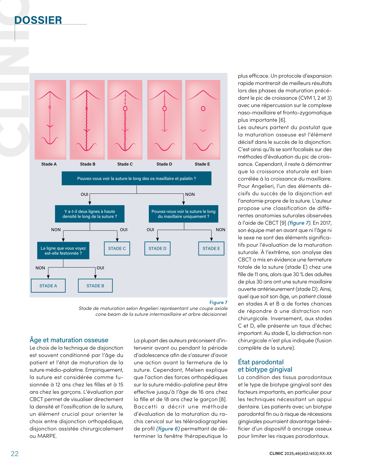 Stades de maturation de la suture intermaxillaire selon Angelieri (coupe axiale CBCT) et arbre décisionnel — CLINIC 2025, figure 7.