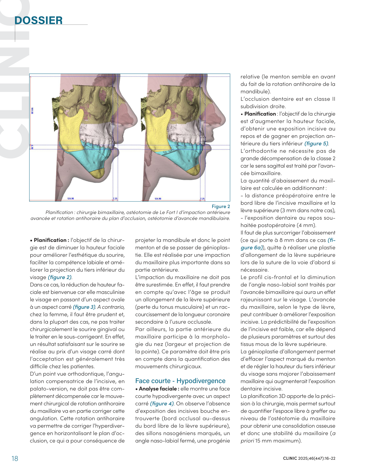 Planification du cas hyperdivergent : chirurgie bimaxillaire, ostéotomie de Le Fort I d'impaction antérieure-avancée et rotation antihoraire du plan d'occlusion — CLINIC 2025, figure 2.