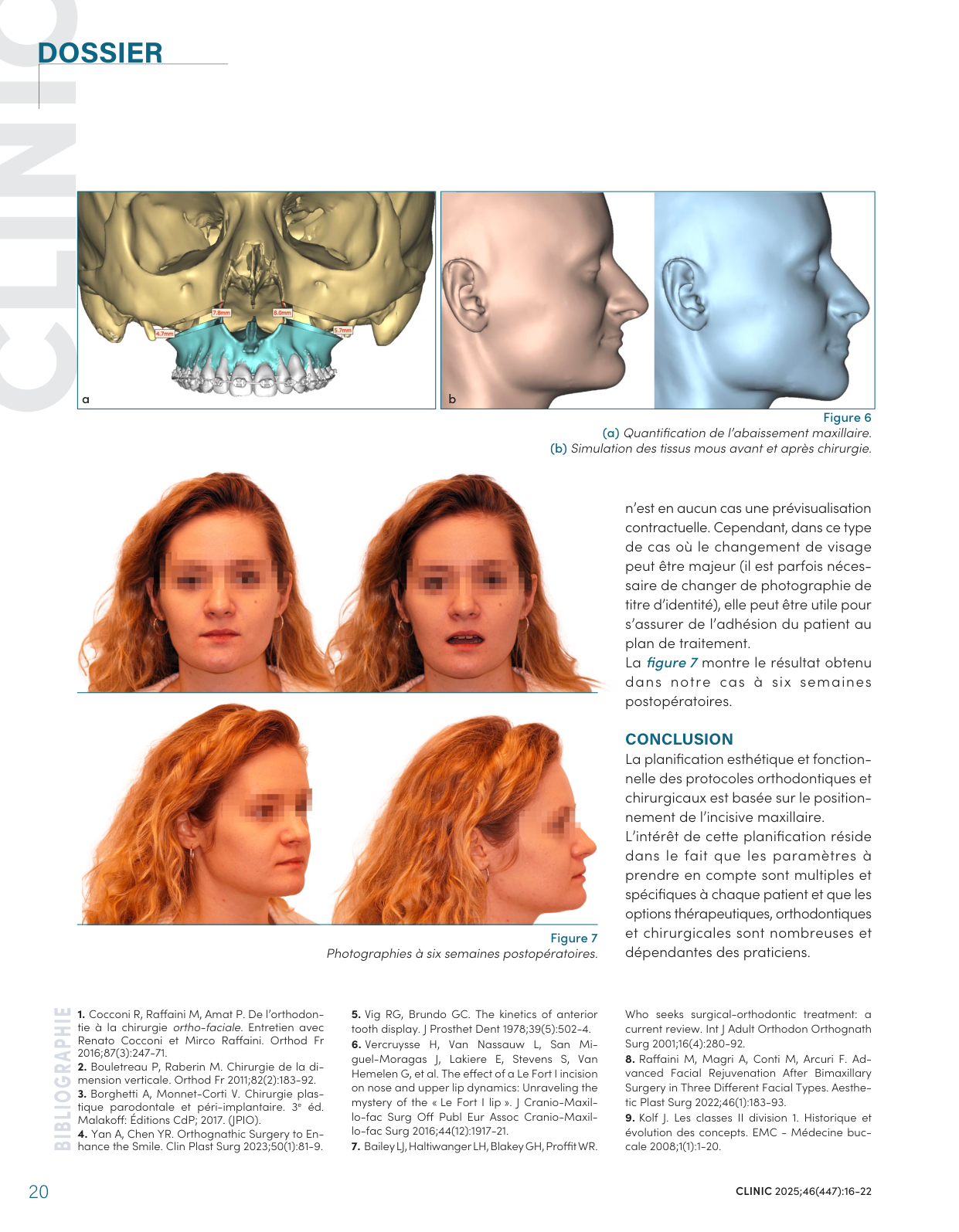 Quantification de l'abaissement maxillaire, simulation des tissus mous et résultat à six semaines postopératoires — CLINIC 2025, figures 6 et 7.