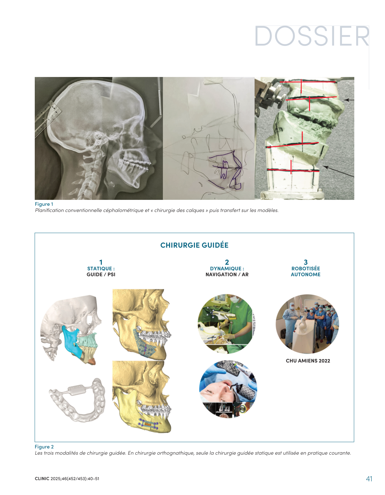 De la planification conventionnelle céphalométrique (« chirurgie des calques ») aux trois modalités de chirurgie guidée — CLINIC 2025, figures 1 et 2.