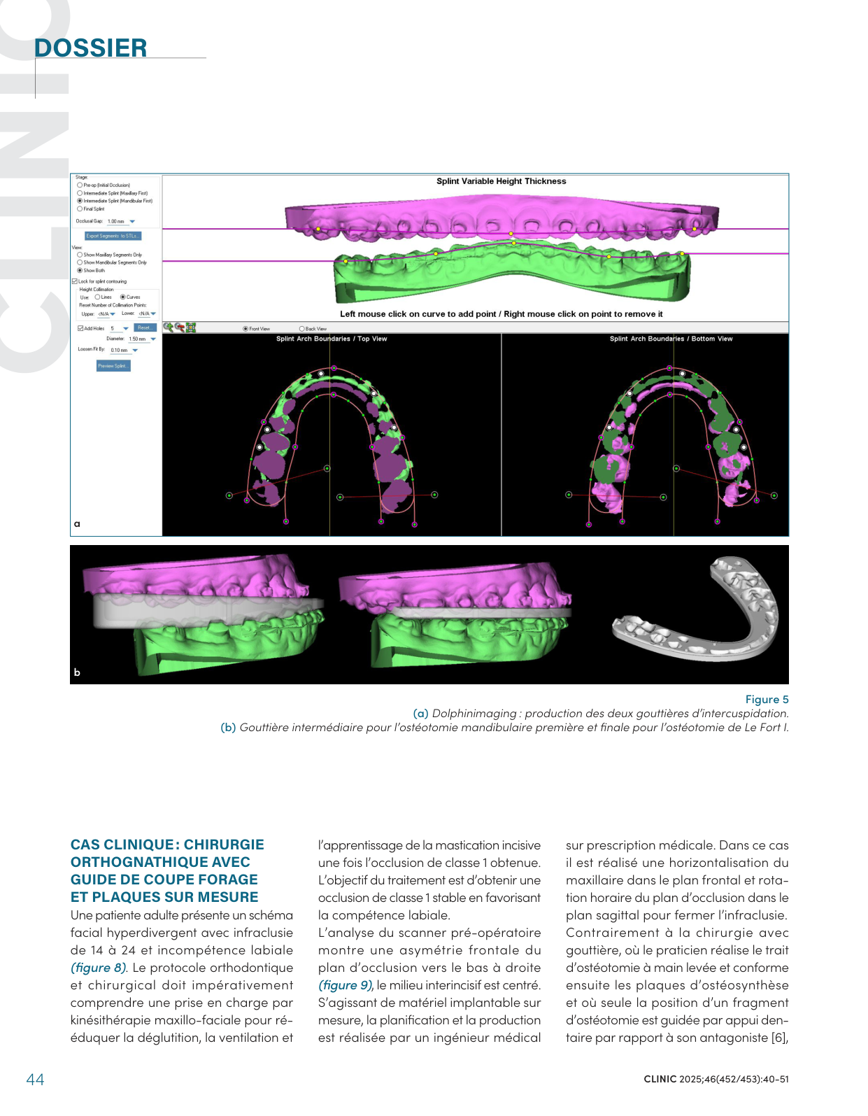 Conception des gouttières d'intercuspidation (Dolphin Imaging) : gouttière intermédiaire pour l'ostéotomie mandibulaire et gouttière finale pour l'ostéotomie de Le Fort I — CLINIC 2025, figure 5.