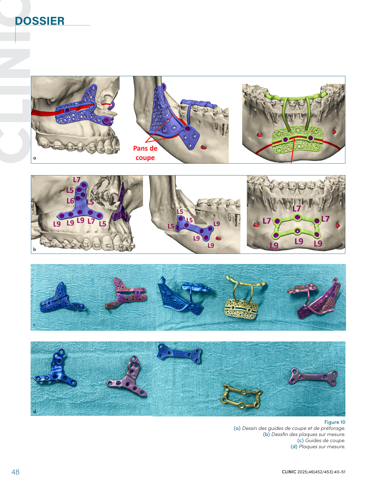 Dessin des guides de coupe et de préforage, plaques sur mesure imprimées en titane — CLINIC 2025, figure 10.