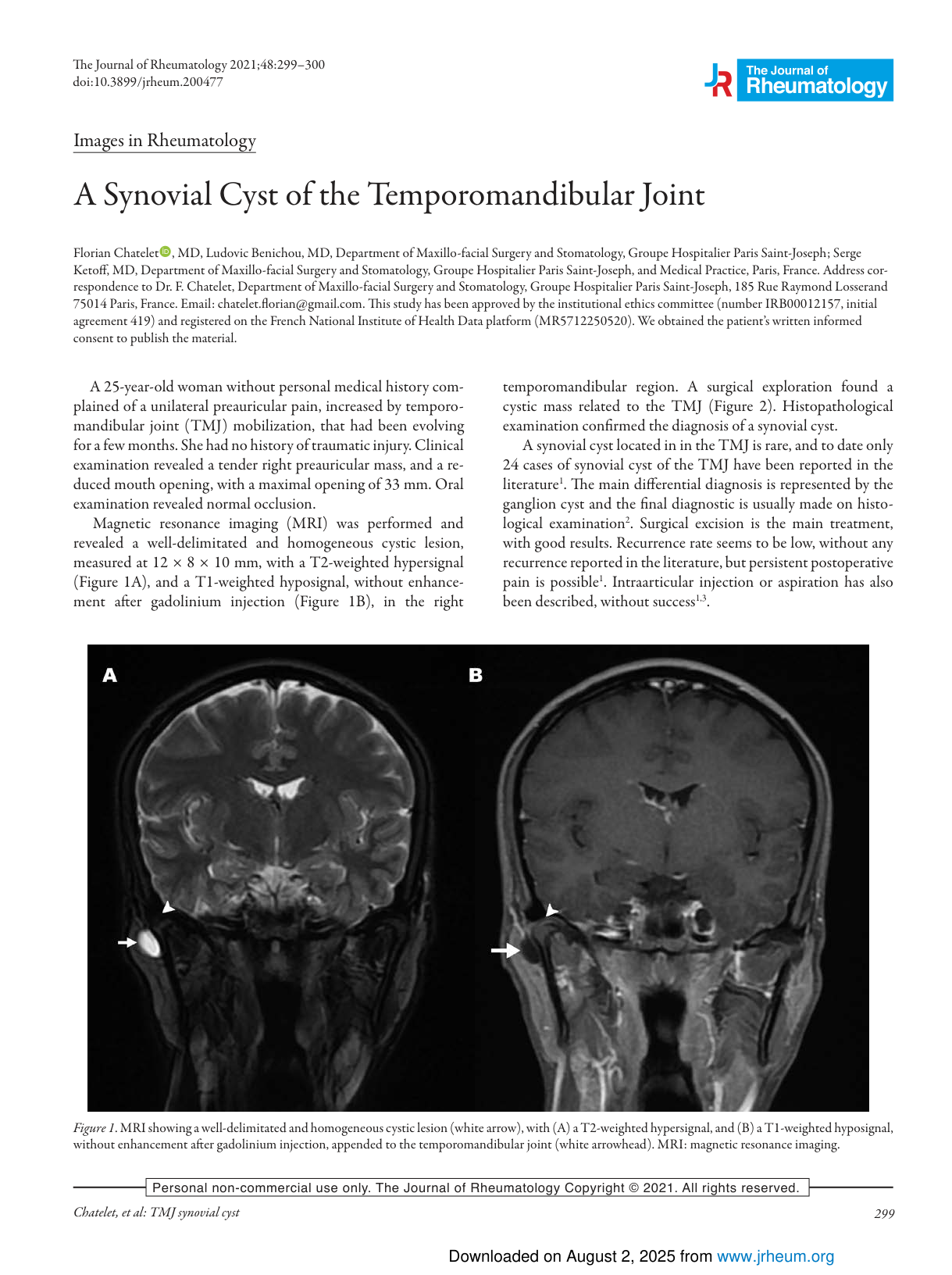Kyste synovial de l'articulation temporo-mandibulaire — J Rheumatol 2021 (première page)